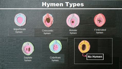 Virginity + Hymen types and causes of Hymen rupture